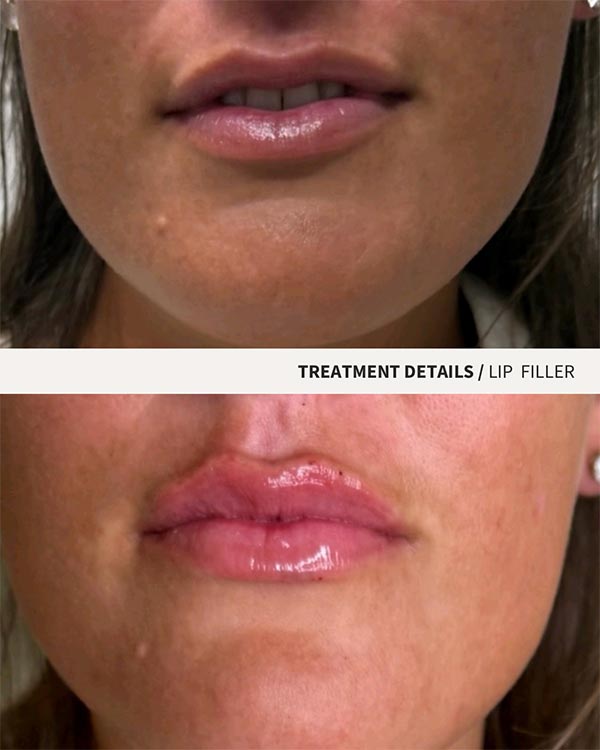 Lip Filler Photo of Juicy Face Medical Esthetics in Denver, CO Lip Filler Photo of Juicy Face Medical Esthetics in Denver, CO