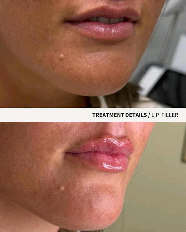 Lip Filler Photo of Juicy Face Medical Esthetics in Denver, CO Lip Filler Photo of Juicy Face Medical Esthetics in Denver, CO