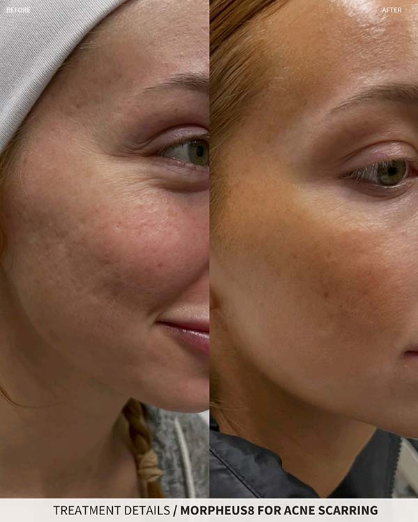 Morpheus8 For Acne Scarring Photo of Juicy Face Medical Esthetics in Denver, CO Morpheus8 For Acne Scarring Photo of Juicy Face Medical Esthetics in Denver, CO