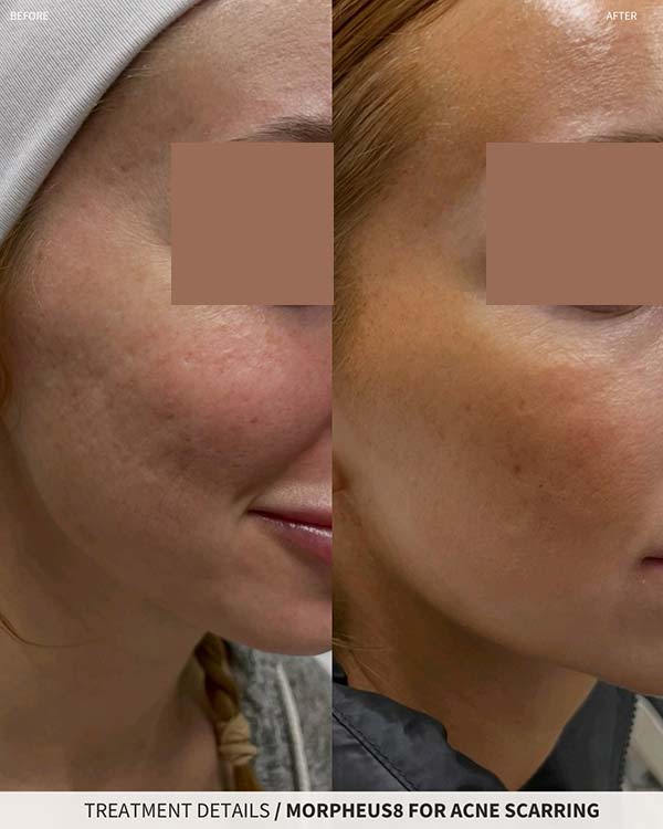 Morpheus8 For Acne Scarring Photo of Juicy Face Medical Esthetics in Denver, CO Morpheus8 For Acne Scarring Photo of Juicy Face Medical Esthetics in Denver, CO